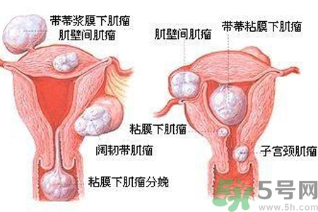 ?子宮移位怎么治療？子宮移位能懷孕嗎？