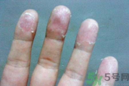 ?手掌脫皮的危害有哪些？如何預(yù)防手掌脫皮？