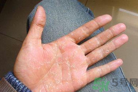 ?手掌脫皮的危害有哪些？如何預(yù)防手掌脫皮？