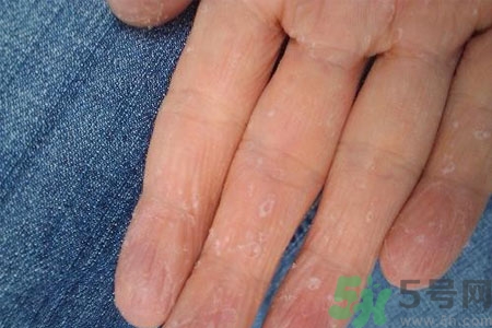 ?手掌脫皮的危害有哪些？如何預(yù)防手掌脫皮？
