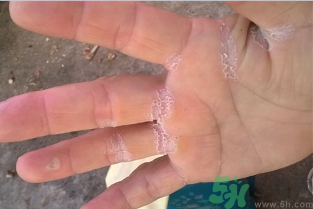 手脫皮是什么原因？手脫皮的治療方法是什么？