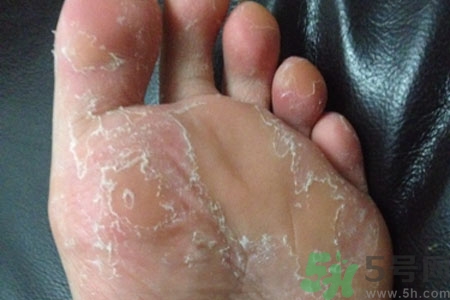 腳脫皮是怎么回事？腳脫皮怎么辦？