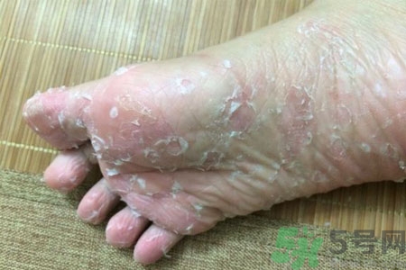 腳脫皮的治療方法有哪些？如何預(yù)防腳脫皮？