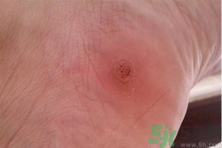 腳上長雞眼是怎么回事？腳上長雞眼是怎么辦？