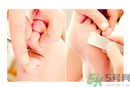 雞眼怎么能徹底根治？如何預(yù)防腳上長(zhǎng)雞眼？