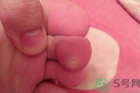 雞眼怎么能徹底根治？如何預(yù)防腳上長(zhǎng)雞眼？