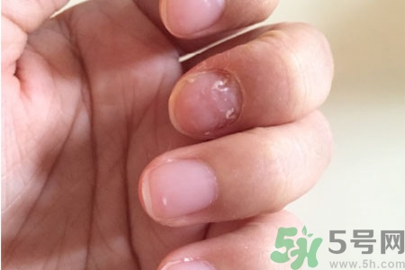 孩子手指甲凹凸不平是什么原因？手指甲凹凸不平的原因是什么？