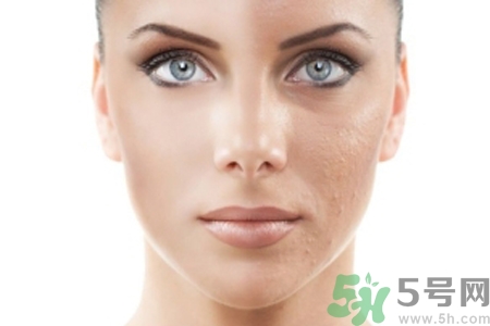 激光縮毛孔多少錢(qián)一次？激光縮毛孔一個(gè)療程多少錢(qián)？