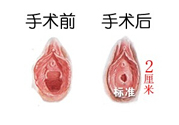 處女膜修補術(shù)效果怎么樣？處女膜修復(fù)手術(shù)有風(fēng)險嗎？