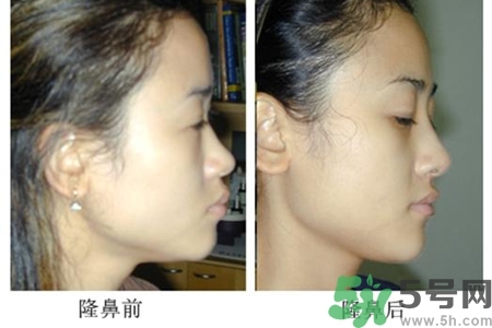 玻尿酸隆鼻的危害有哪些？玻尿酸隆鼻的副作用是什么？