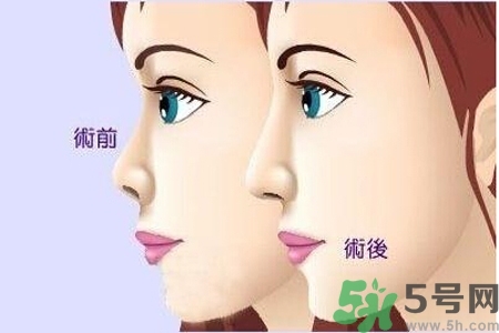 玻尿酸隆鼻的缺點(diǎn)是什么？玻尿酸隆鼻的優(yōu)點(diǎn)有哪些？