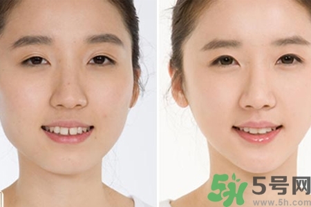 玻尿酸隆鼻的缺點(diǎn)是什么？玻尿酸隆鼻的優(yōu)點(diǎn)有哪些？