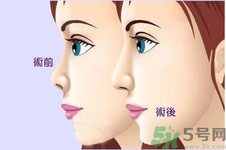 玻尿酸隆鼻和手術(shù)隆鼻的區(qū)別是什么？