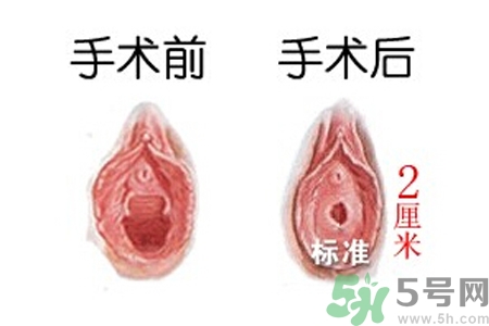 什么人不能做處女膜修補(bǔ)術(shù)？處女膜修補(bǔ)術(shù)會(huì)留疤嗎？