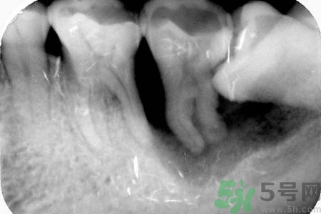 拔智齒一顆多少錢？拔除智齒收費(fèi)多少？