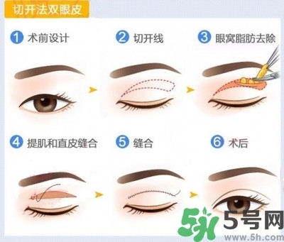 雙眼皮手術(shù)哪種最好？割雙眼皮后注意些什么？
