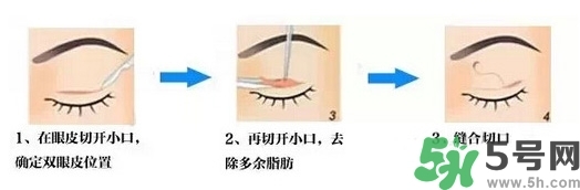 雙眼皮手術(shù)哪種最好？割雙眼皮后注意些什么？