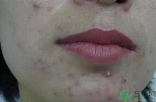 什么樣的痘痘能擠？哪些痘痘不能擠？