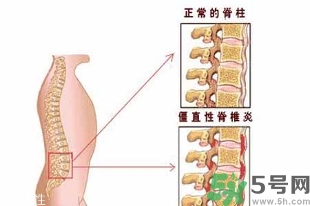 僵直性脊椎炎的癥狀有哪些？怎樣預防僵直性脊椎炎？