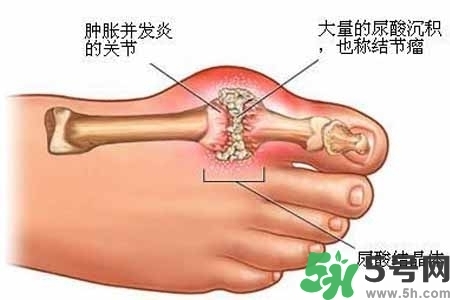 引發(fā)痛風的原因是什么？痛風病人飲食需注意什么好？