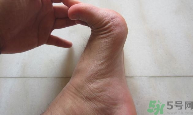 腳拇指外翻遺傳嗎？腳拇指外翻怎么矯正？