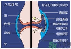 骨關(guān)節(jié)炎能治好嗎？骨關(guān)節(jié)炎平時(shí)注意事項(xiàng)