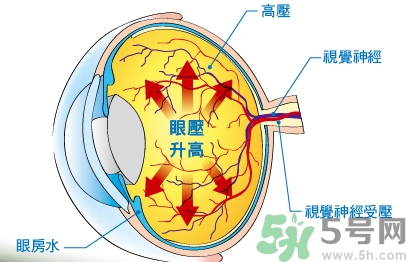 青光眼可以治愈嗎？青光眼怎樣治療？