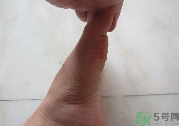 腳拇指外翻遺傳嗎？腳拇指外翻怎么矯正？