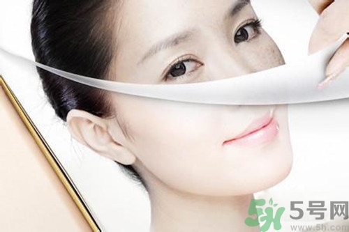 曬斑可以自己消退嗎？曬斑可以用激光去除嗎？