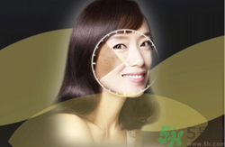 曬斑可以自己消退嗎？曬斑可以用激光去除嗎？