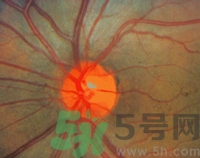 青光眼可以治愈嗎？青光眼怎樣治療？