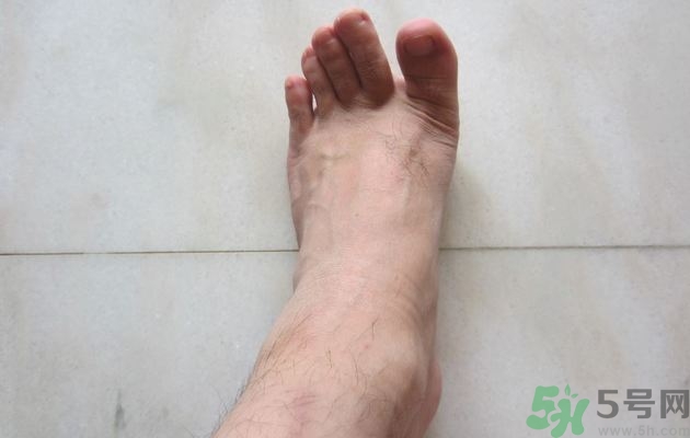 腳拇指外翻遺傳嗎？腳拇指外翻怎么矯正？