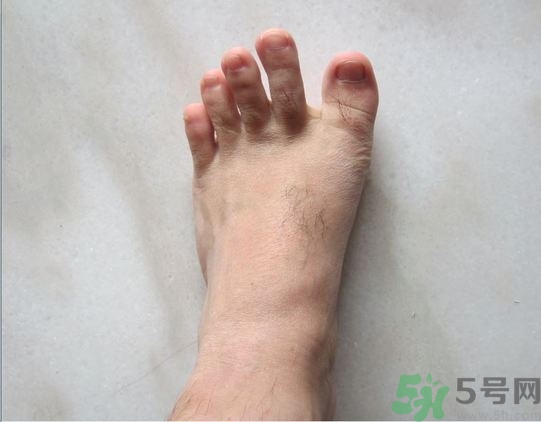 腳拇指外翻遺傳嗎？腳拇指外翻怎么矯正？