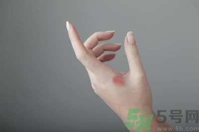 手被燙紅了怎么辦？手被燙了怎么止痛？
