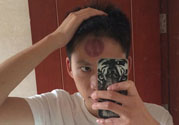 頭痛可以在額頭上拔火罐嗎？額頭上拔火罐有什么好處？