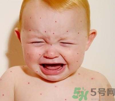 新生兒濕疹怎么引起的？新生兒濕疹如何處理？