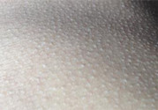 激光可以去雞皮膚嗎?激光去雞皮膚多少錢(qián)
