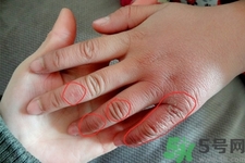 治療凍瘡用什么藥最好?凍瘡吃什么水果好? 治療凍瘡用什么藥最好?凍瘡吃什么水果好?