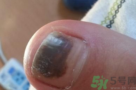 腳趾甲變黑是什么原因？腳趾甲變黑是怎么回事？