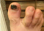 腳趾甲變黑是什么原因？腳趾甲變黑是怎么回事？
