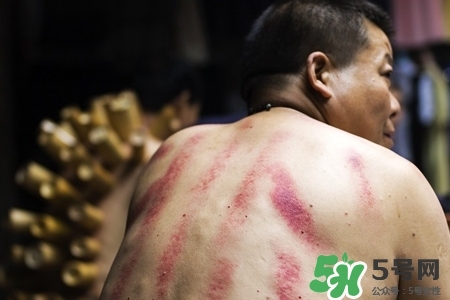 背部刮痧后能拔火罐嗎？背部刮痧后拔火罐有什么好處？