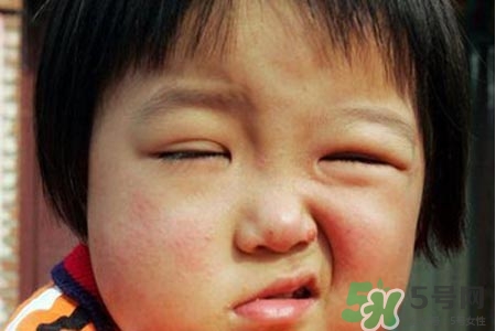 面癱能針灸嗎？針灸能治療面癱嗎？
