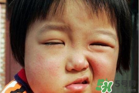 拔牙會(huì)導(dǎo)致面癱嗎?？拔牙為什么會(huì)導(dǎo)致面癱？