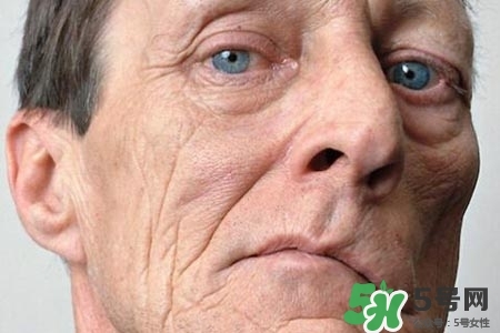 老年人為什么容易得面癱？老年人面癱原因有哪些？