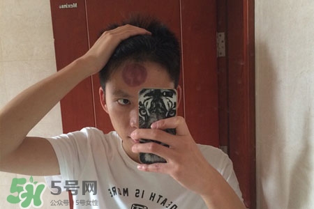 拔罐后皮膚癢能撓嗎？拔罐后身上癢切忌抓撓
