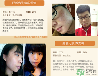 芷軒堂祛痘有效果嗎？芷軒堂祛痘印效果怎么樣？
