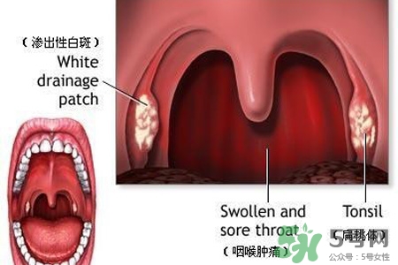 口含大蒜能治療咽炎嗎？巧用大蒜治療咽炎咳嗽