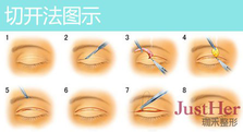 定點雙眼皮怎么做？定點雙眼皮需要拆線嗎？