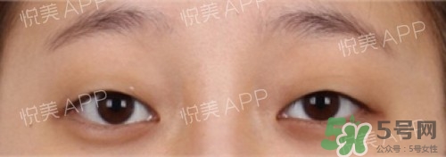 埋線雙眼皮多久恢復(fù)自然？埋線雙眼皮多久能恢復(fù)
