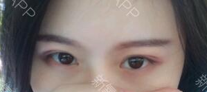 定點(diǎn)雙眼皮能保持多久？定點(diǎn)雙眼皮是永久的嗎？